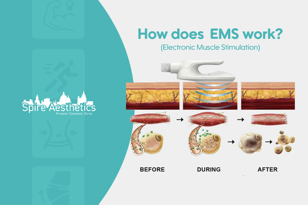 EMS treatment for post pregnancy weight loss treatment Market Mowbray