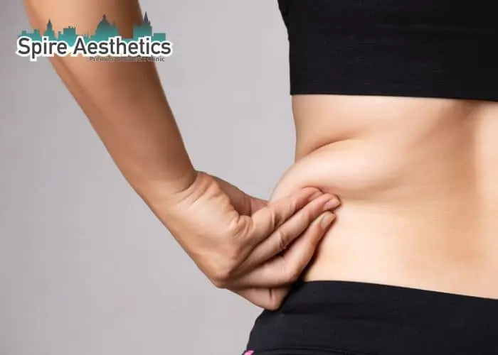 Image of woman pinching fat on their hips Market Mowbray. Fat Freezing treatment