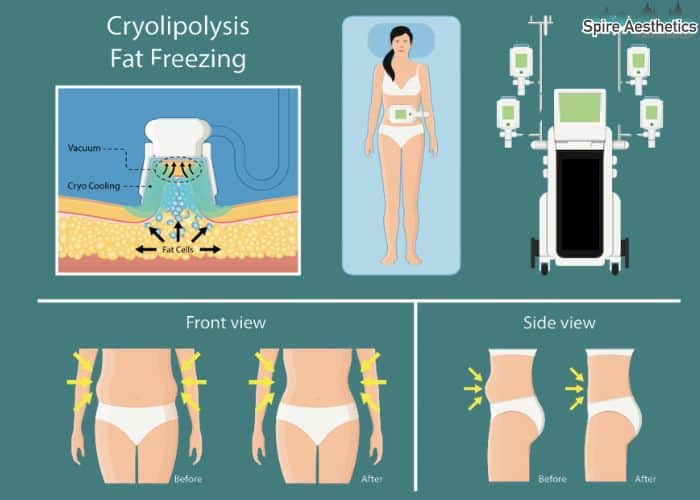 Image of diet and fat freezing combined for best results for Spire Aesthetics Market Mowbray
