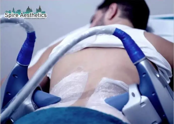 Man having fat freezing treatment done on love handles before a competitions Market Mowbray to create a sculpted look.