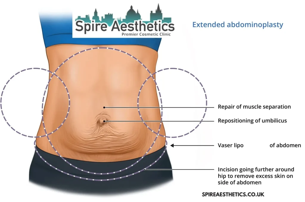 Understanding Loose Skin After Gastric Band Market Mowbray Surgery and HIFU Treatment