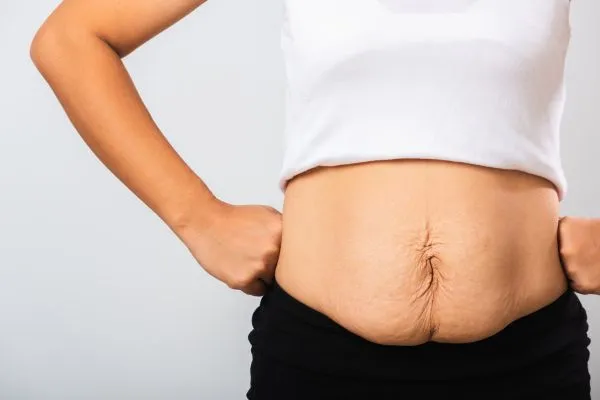 Image of a woman's stomach after weight loss with sagging skin following a gastric band Market Mowbray
