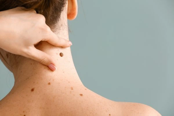 skin blemish removal Market Mowbray treatment