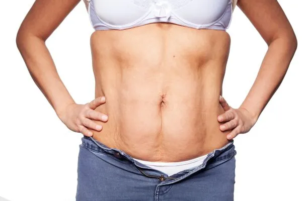 sagging skin on woman's stomach after weight loss injections Market Mowbray