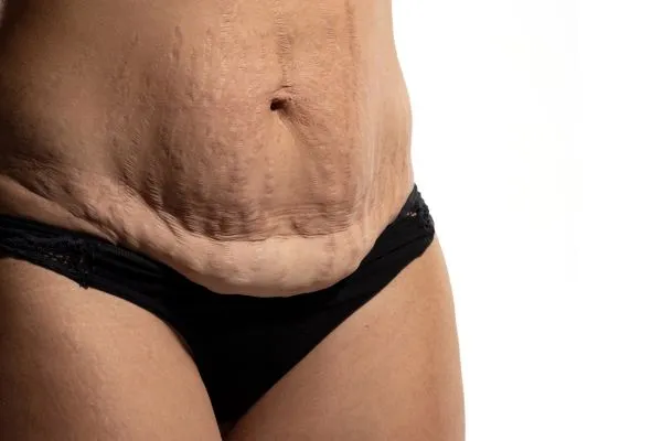 Image of womans stomach after weight loss injections Market Mowbray showing saggy skin