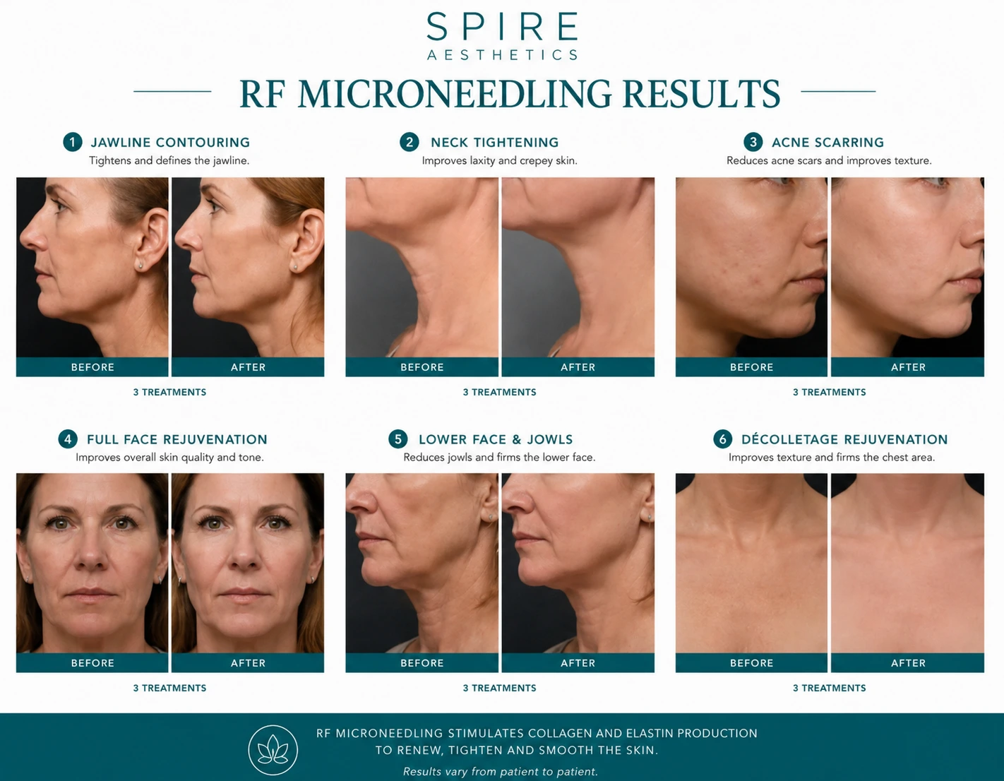 RF Microneedling Skin tightening Market Mowbray results