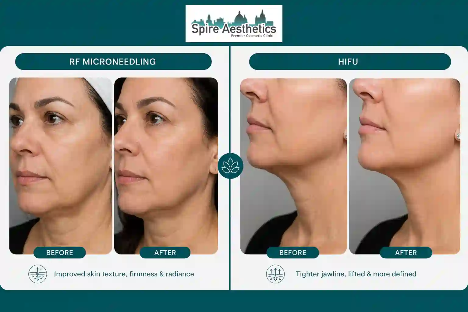 Can RF Microneedling and HIFU Be Combined Market Mowbray?