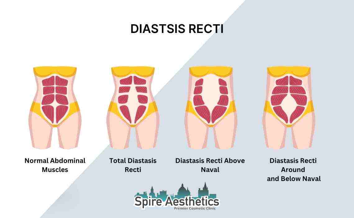 Is Non-Surgical Diastasis Recti Treatment Right for You? Common Concerns Answered Market Mowbray